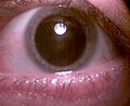 Iris dilated for retina examination.