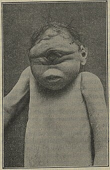 Infant with full arrhinia in cyclopia Roland Cyclopie 2.jpg