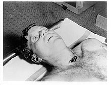 President Kennedy during the autopsy, displaying an exit wound below his neck A picture of President Kennedy's head and shoulders taken at the autopsy.jpg