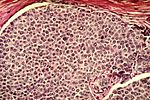صورة مصغرة لـ خلية سرطانية