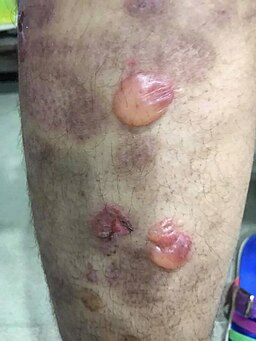 Bullous pemphigoid new image