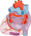 Myocardial infarction - Posteroinferior infarct