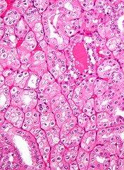 Micrograph of chromophobe RCC oncocytic variant, the main differential diagnosis of renal oncocytoma.