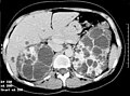 CT of patient with polycystic kidney disease.