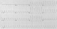 Image illustrative de l’article Tachycardie ventriculaire