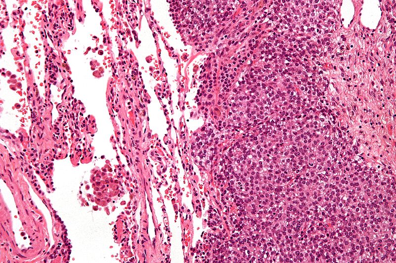 File:Ewing sarcoma - high mag.jpg