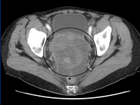 Peritonealis rák mesothelioma
