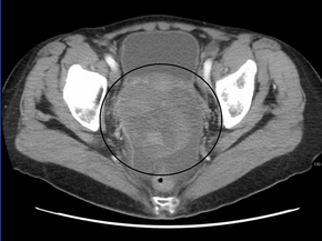 A very large ovarian cancer as seen on CT POvarianCA.png