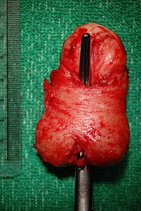 Prostate with a prominent middle lobe.