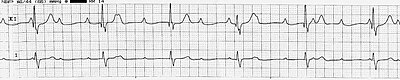 Leads I and II demonstrating complete AV block. Note that the P waves are not related to the QRS complexes (PP interval and QRS interval both constant), demonstrating that the atria are electrically disconnected from the ventricles. The QRS complexes represent an escape rhythm arising from the ventricle. Rhythm strip showing third degree heart block.jpg