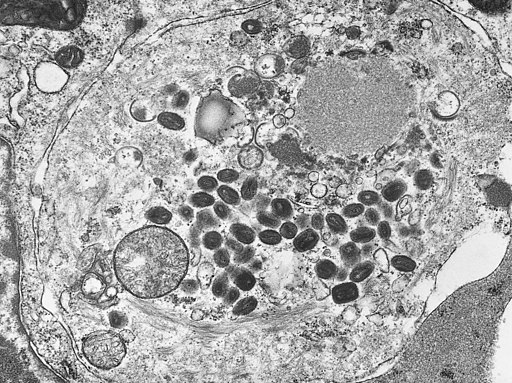 Smallpox Tissue section containing variola orthopox viruses TEM PHIL 2291 lores