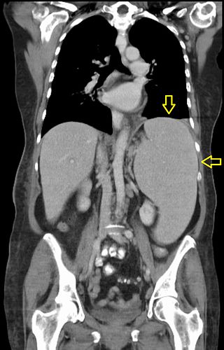 <span class="mw-page-title-main">Splenomegaly</span> Medical condition