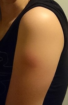 A bump resulting from a tetanus vaccine injection Tetanusimpfung - Tag danach Crop.jpg