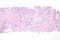 Micrograph of urethral urothelial cell carcinoma. Hematoxylin and eosin stain.