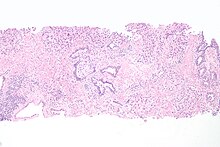 Micrograph of urethral cancer (urothelial cell carcinoma), a rare problem of the urethra. Urethral urothelial cell carcinoma.jpg