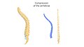 Vertebral fracture - Compression of the vertebrae