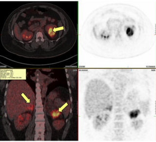 <span class="mw-page-title-main">Congenital adrenal hyperplasia due to 21-hydroxylase deficiency</span> Medical condition