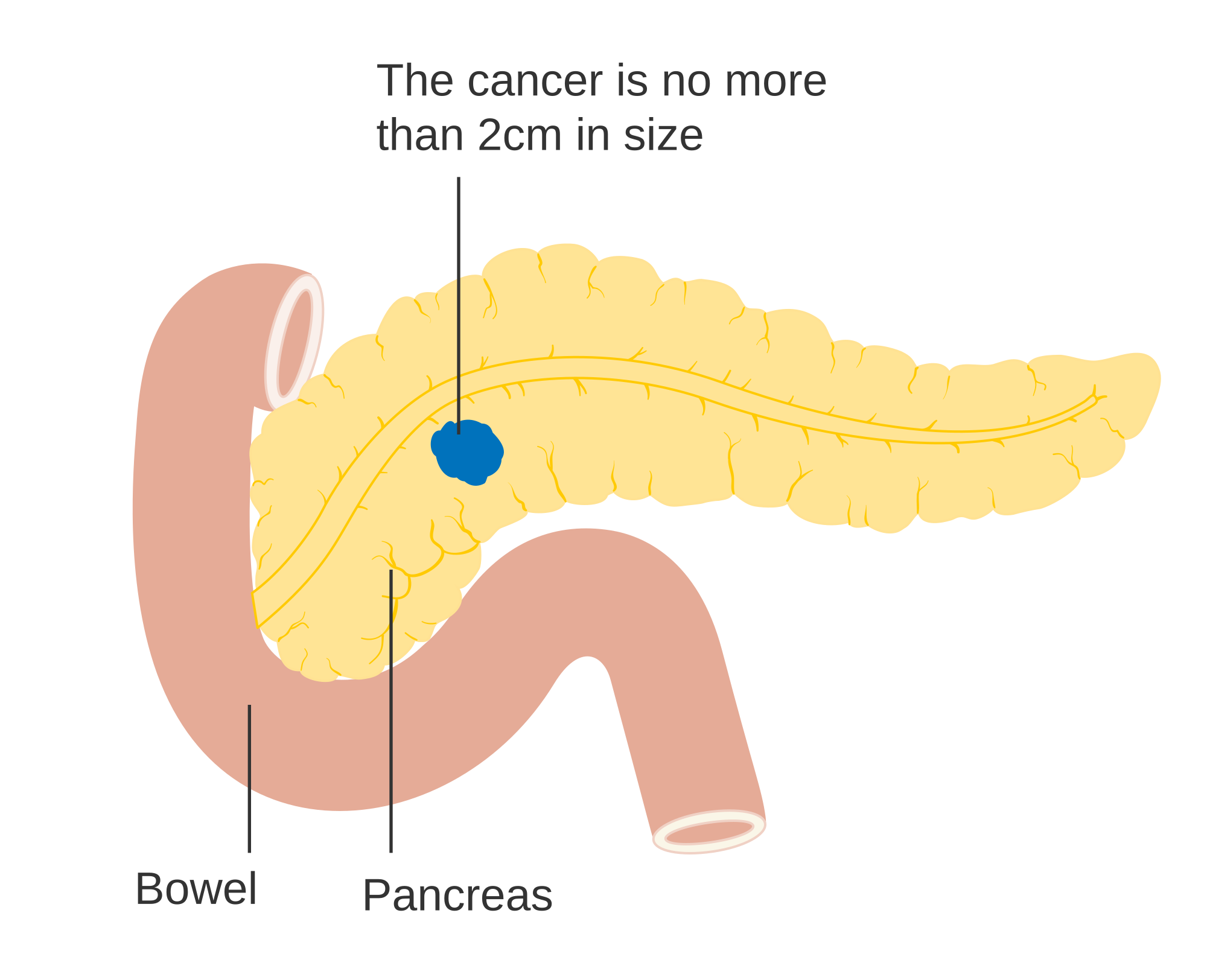 2000px-Diagram_showing_stage_T1_cancer_of_the_pancreas_CRUK_246.svg.png