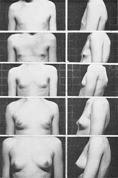Photos of the Tanner scale for females Female breasts five Tanner stages.jpg