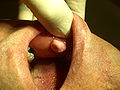 Fibroma of the oral mucosa