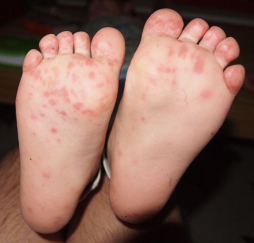 Hand foot and mouth disease on child feet