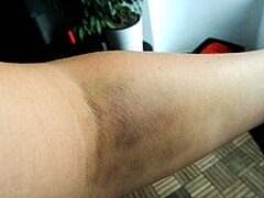 Large hematoma on an arm.jpg