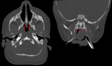 Membranoese Choanalatresie beidseits NG - CT axial und coronar - 001 -Annotationen.png