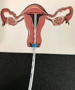 Mirena intrauterine device insertion.jpg