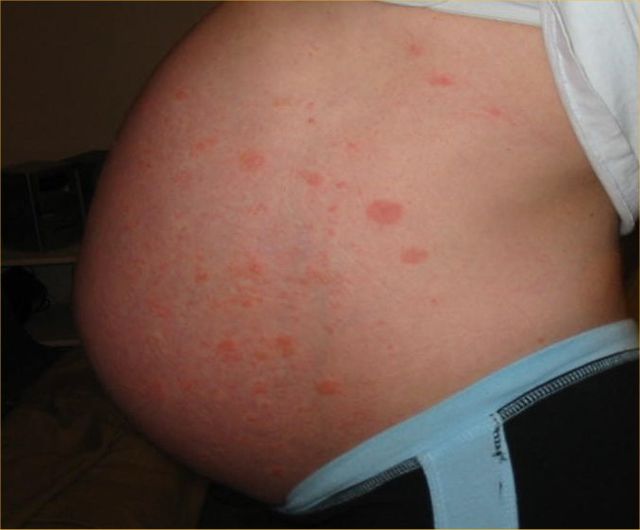 Pruritic rash on trunk  MDedge Family Medicine