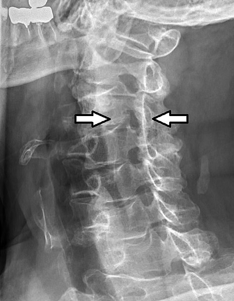 File:Projectional radiograph of cervical foraminal stenosis, annotated.jpg