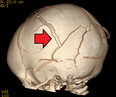 3D CT reconstruction showing a skull fracture in an infant