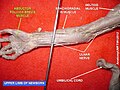 Krátky odťahovač palca (Abductor pollicis brevis muscle)