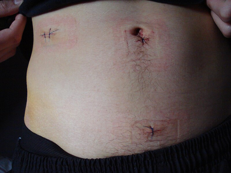 File:Stitches post appendicitis surgery.jpg