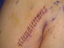 Surgical staples2.JPG