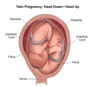 Breech Birth