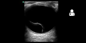 File:UOTW 12 - Ultrasound of the Week 1.webm