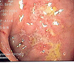 CD serpiginous ulcer.jpg