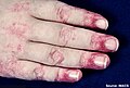 Dermatomyositis7.jpg