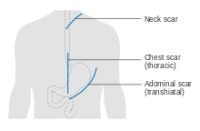 Typical scar lines after the two main methods of surgery Diagram showing the possible scar lines after surgery for oesophageal cancer CRUK 364.svg