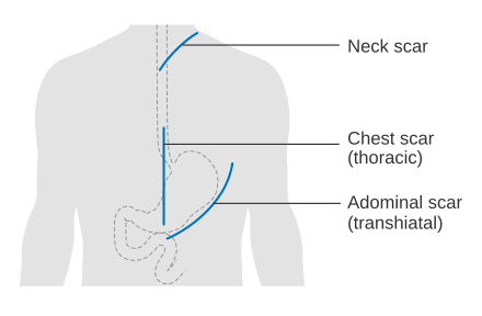 Typical scar lines after the two main methods of surgery