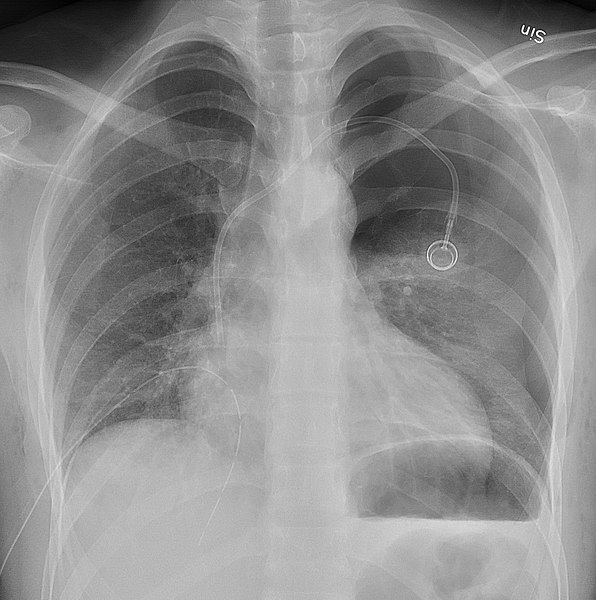 File:Expired X-ray of pneumothorax.jpg