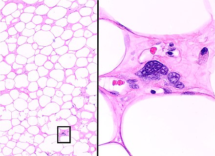 ALT/WDL, adipocytic/lipoma-like. At low magnification, the tumor mostly contains adipocytes that appear benign and mature, but high magnification of one fibrous band shows abnormal spindle-shaped cells with enlarged, heterochromatic nuclei.