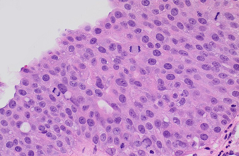 File:Histopathology of high grade urothelial carcinoma.jpg