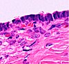 Histopathology of serous cystadenoma.jpg