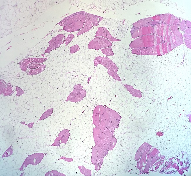 File:Intramuscular Lipoma (38578598922).jpg