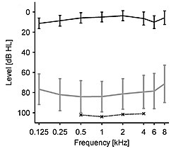 Loudness discomfort levels (LDLs): group data of hyperacusis patients without hearing loss. Upper line: average hearing thresholds. Lower long line: LDLs of this group. Lower short line: LDLs of a reference group with normal hearing. LDL-Audiogram.jpg
