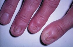 Lichen planus involving the nails