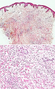 Micrograph of neutrophilic urticarial dermatosis.jpg