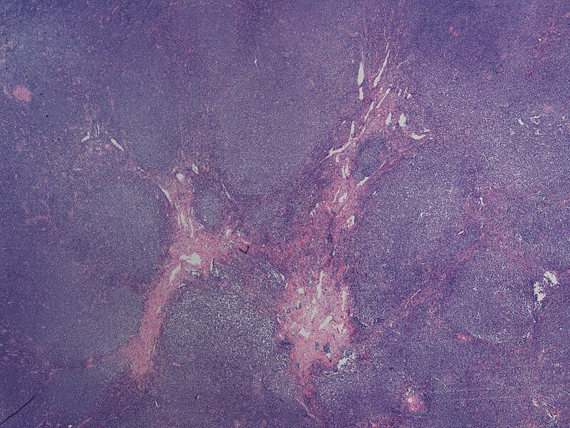 File:Nodular Mantle Cell Lymphoma - low power view - by Gabriel Caponetti.jpg