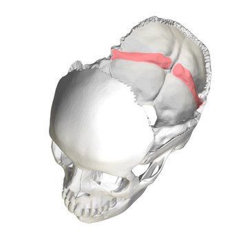 Groove for transverse sinus